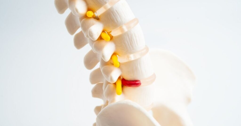 Pilates para Hérnia de Disco